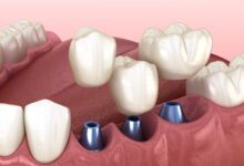 Concept de pose d’implants dentaires