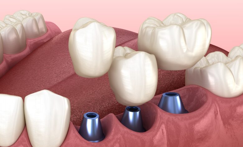 Concept de pose d’implants dentaires
